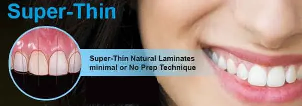 home ultra thin veneers